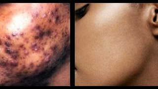 How to Remove Dark amp Black Spots on Face  Get Flawless Glowing Skin  superWOWstyle [upl. by Neehar994]