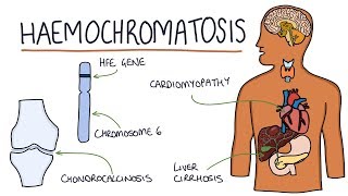 Understanding Haemochromatosis [upl. by Latsryk]