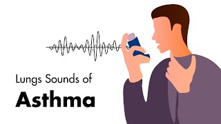 Sounds of Asthma  Wheezing Lung Sounds [upl. by Oicirtap]