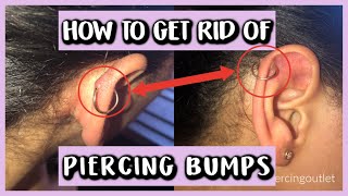 HOW TO GET RID OF PIERCING BUMPS [upl. by Giles]