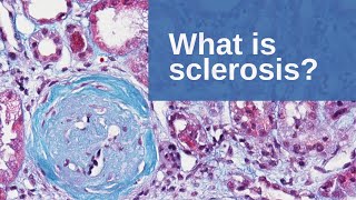 Tuberous Sclerosis with Subependymal Giant Cell Astrocytoma [upl. by Meli]