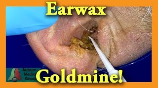 Earwax GOLDMINE  Auburn Medical Group [upl. by Mac777]