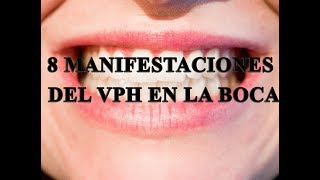 8 manifestaciones de VPH en la boca [upl. by Aratak]