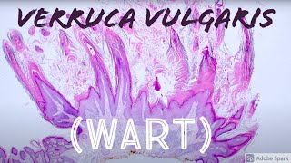 Wart Under the Microscope Verruca Vulgaris vs Seborrheic Keratosis Pathology [upl. by Yllah171]