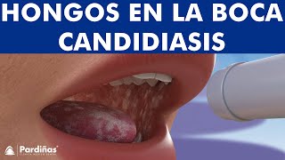 CANDIDIASIS oral y BOQUERAS  Cómo CURAR los hongos de la boca © [upl. by Taddeo804]