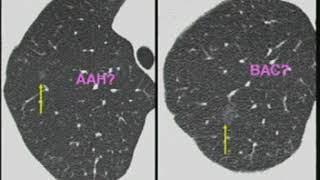 Pulmonary Nodules Imaging Analysis and Management [upl. by Adnilreh]