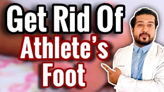 How to Treat Athletes Foot FOR GOOD 2021 [upl. by Aihsenat]