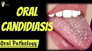 ORAL PATHOLOGY  ORAL CANDIDIASIS [upl. by Butcher145]