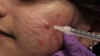 Watch amp Learn Intralesional injections [upl. by Claretta]