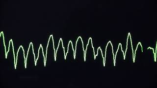 Cardiac arrest rhythms VF VT Asystole and PEA [upl. by Zendah]