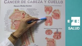 Cáncer en la boca por infecciones tabaco y alcohol [upl. by Zitella178]