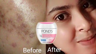 Best Dark Spot Remover Cream 2021 [upl. by Ardnuassak]