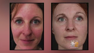 Health Watch New Laser Treatment For Rosacea [upl. by Gotthelf]