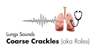 Coarse Crackles Rales  Lung Sounds  Medzcool [upl. by Vally19]