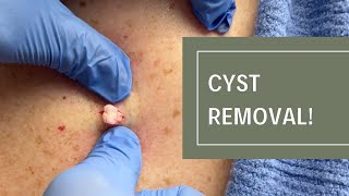 Cyst Removal  Dr Derm [upl. by Ahsirak]