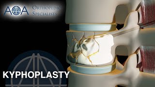 Kyphoplasty An Overview [upl. by Unders107]