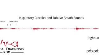 The Lung Sounds of Pneumonia [upl. by Hollinger]