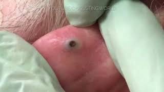 Largest Earring hole blackhead ever [upl. by Killian]