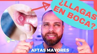 LLAGAS en la BOCA 😩 Conoce por qué SALEN y Cómo se CURAN 3 Tipos ⛑ [upl. by Niletac]