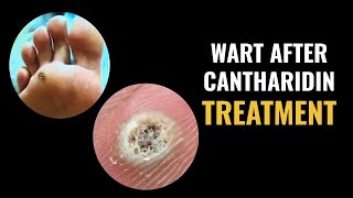 Wart After Cantharidin Treatment [upl. by Rizika]