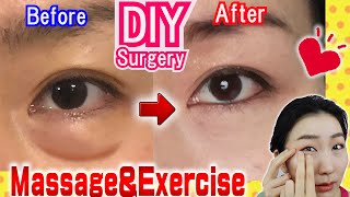 How to Remove Under Eye Bags👁️ Naturally in 7 Days Massage amp Exercises🙋 [upl. by Anirav]