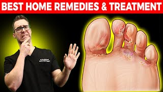 Athletes Foot Fungus BEST Home Remedies amp Treatment [upl. by Kosey]